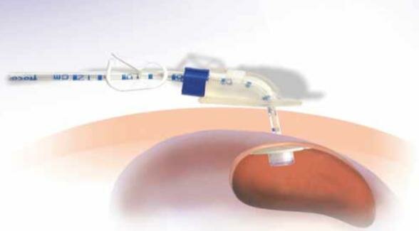 Ernæringssonde i mavesækken (perkutan endoskopisk gastrostomi